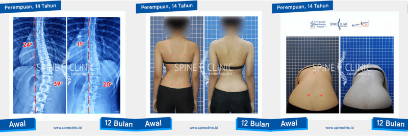 skoliosis bisa sembuh